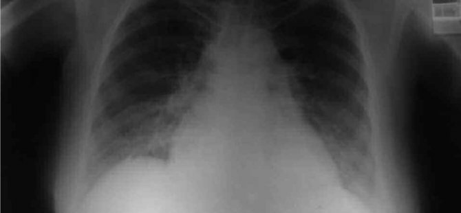 Kocaeli’nin “Pnömonili” verilerini yanlış girmişler!