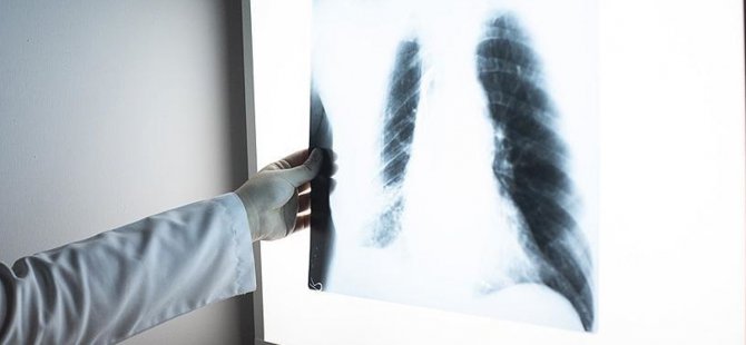 Sigara akciğere kızgın bir iğnenin batması gibi zarar veriyor