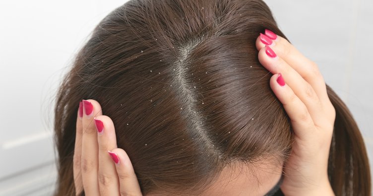 Saçtaki kepeğe ne iyi gelir?