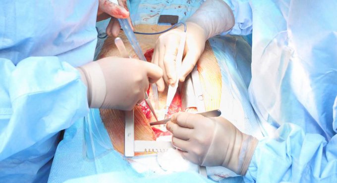 Kalp ameliyatlarında küçük kesi yönteminin 7 avantajı