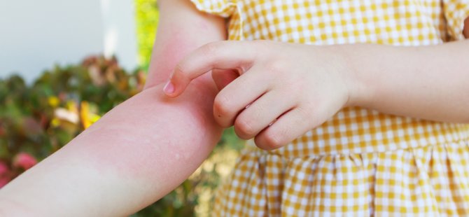 ÇOCUKLARDA ‘ALERJİK HASTALIKLAR’ HAKKINDA DOĞRU SANILAN 8 HATALI BİLGİ!