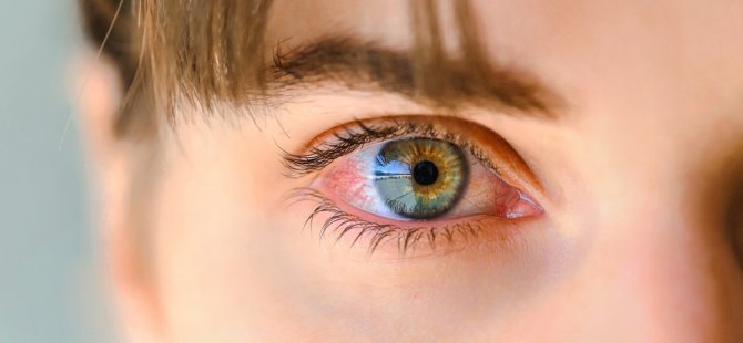 Gözde oluşan arpacığa asla sarımsak sürmeyin!