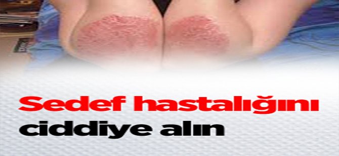 Sedef hastalığını ciddiye alın