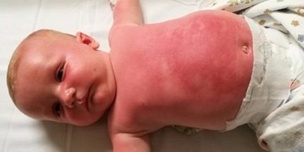 Güneş kremi 3 aylık bebeği yaktı!