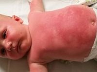 Güneş kremi 3 aylık bebeği yaktı!