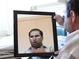 6. yüz nakli hayatını kaybetti